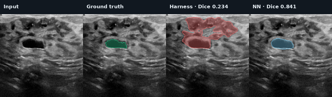 BUSI lower quartile case: input, ground truth, Harness, and fixed NN ensemble