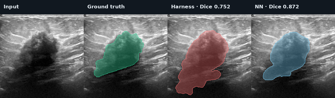 BUSI median case: input, ground truth, Harness, and fixed NN ensemble