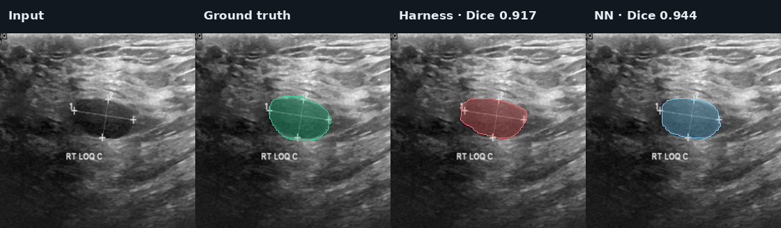 BUSI upper quartile case: input, ground truth, Harness, and fixed NN ensemble