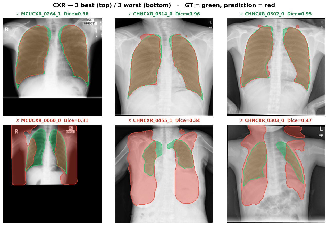 CXR best/worst