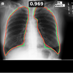 Test image MCUCXR_0040_0, Dice 0.969