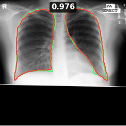 Test image MCUCXR_0049_0, Dice 0.976