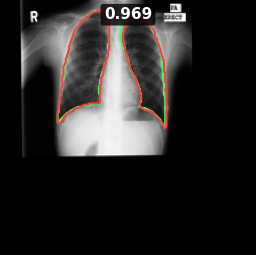 Test image MCUCXR_0060_0, Dice 0.969