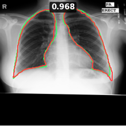 Test image MCUCXR_0062_0, Dice 0.968