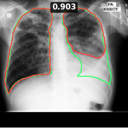 Test image MCUCXR_0150_1, Dice 0.903