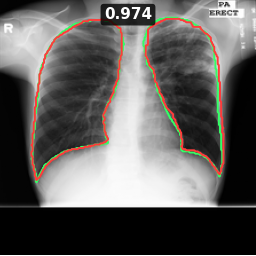 Test image MCUCXR_0264_1, Dice 0.974