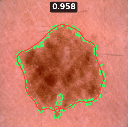 Test image ISIC_0014758, Dice 0.958