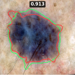 ISIC_0015438 Dice 0.913