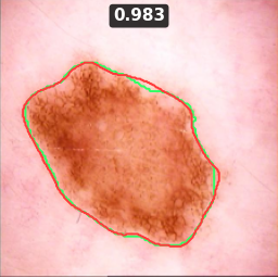 Test image ISIC_0017026, Dice 0.983