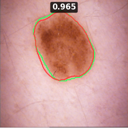 Test image ISIC_0018738, Dice 0.965