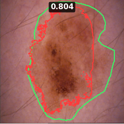 Test image ISIC_0019910, Dice 0.804