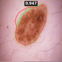 Test image ISIC_0019989, Dice 0.947