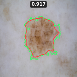 Test image ISIC_0022571, Dice 0.917