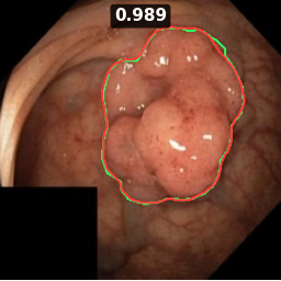 Kvasir-SEG — Polyp (endoscopy)