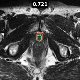 Test image prostate_07_z010, Dice 0.721