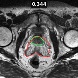 prostate_07_z016 Dice 0.344
