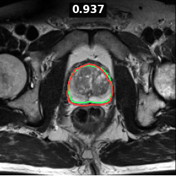 Test image prostate_31_z008, Dice 0.937