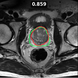 prostate_31_z012 Dice 0.859