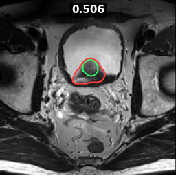 Test image prostate_31_z018, Dice 0.506