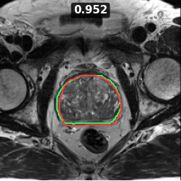 Test image prostate_38_z010, Dice 0.952