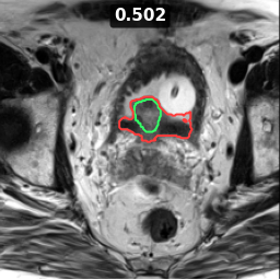 Test image prostate_39_z013, Dice 0.502