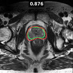 Test image prostate_46_z010, Dice 0.876