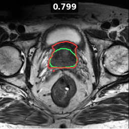 Test image prostate_46_z014, Dice 0.799