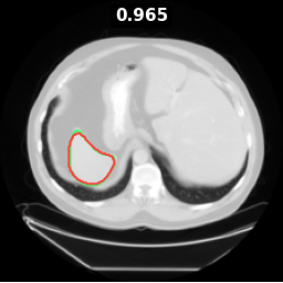 MSD Spleen — Spleen (CT)