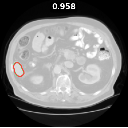 spleen_61_z063 Dice 0.958