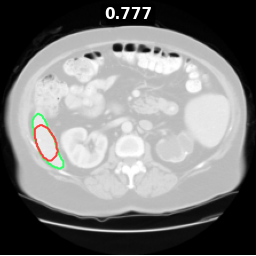 spleen_8_z010 Dice 0.777