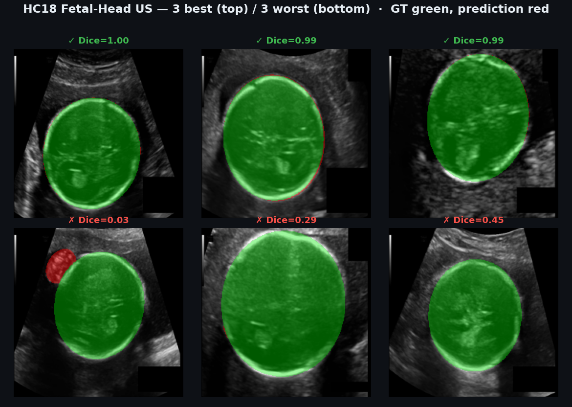 HC18 fetal-head best/worst