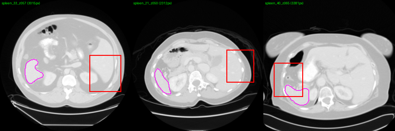 Three abdominal CT slices: magenta contour marks the ground-truth spleen on the image left; the red MLLM box sits on the liver at the image right.