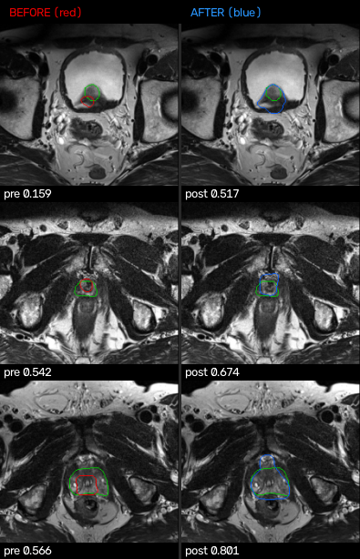 MSD Prostate &middot; REPAIR (isodense boundary)