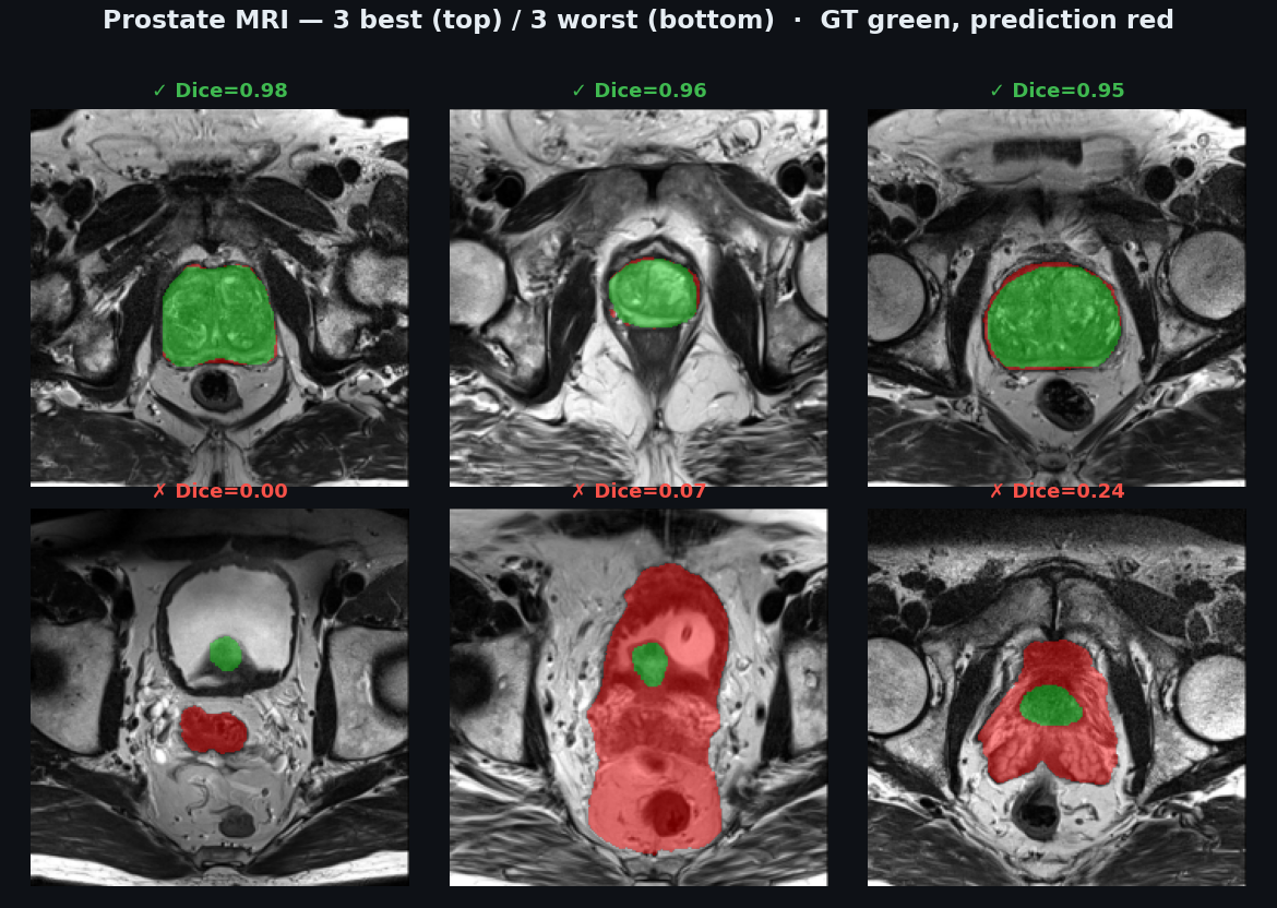 prostate MRI best/worst